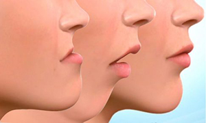 Ciruga ortogntica | Maxilofacial Zaragoza | Dra. Mnica Lafont