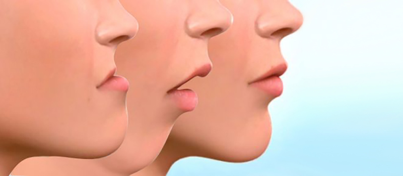 Ciruga ortogntica | Maxilofacial Zaragoza | Dra. Mnica Lafont