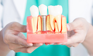 Implantologa | Maxilofacial Zaragoza | Dra. Mnica Lafont
